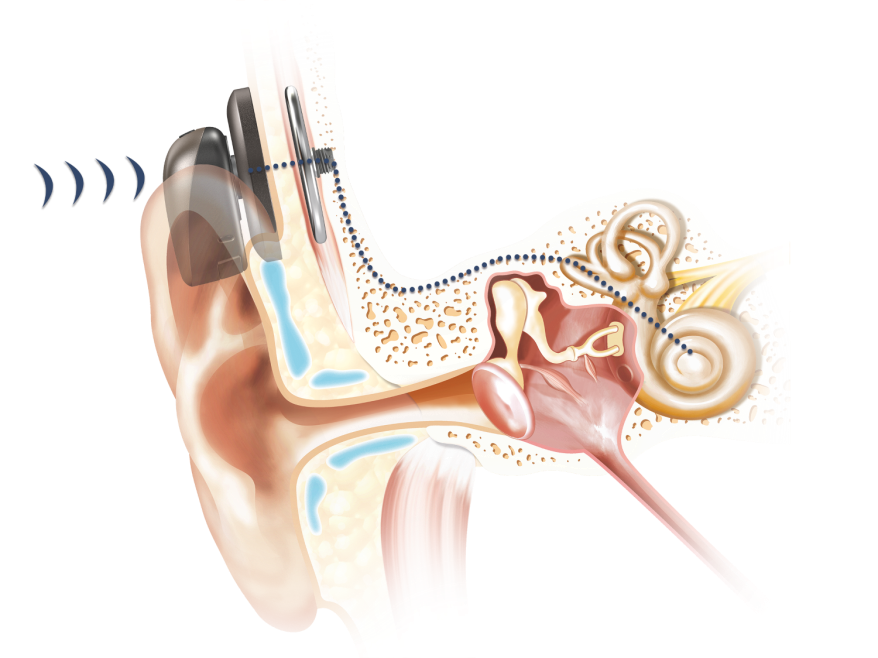 BAHA system consists of an internal implant and sound processor